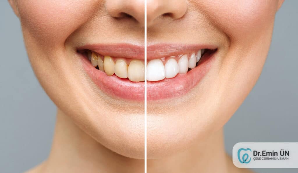 Diş Beyazlatma - Bleaching kayseri