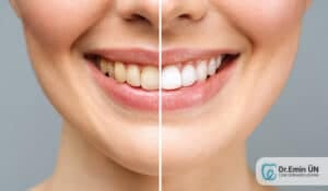 Diş beyazlatma bleaching uygulaması ve estetik gülüş