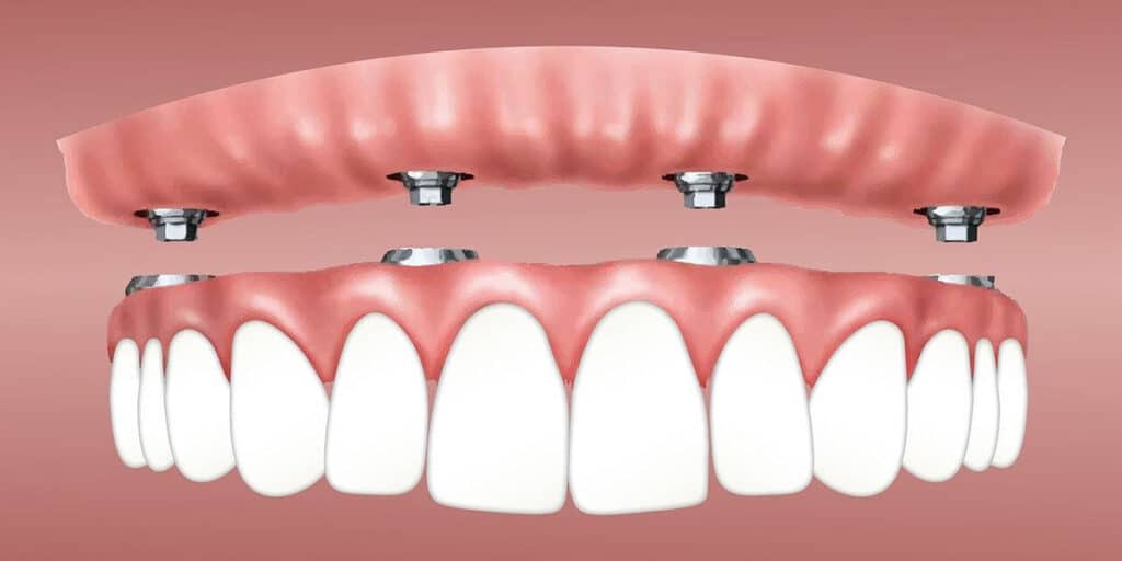 kayseri all on four implant tedavisi çene cerrahı dr emin ün