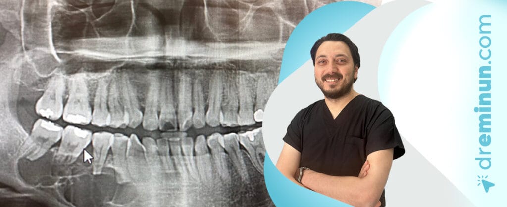 Çene Kemiği Kisti ve Tümör Tedavisi Kayseri | Dr. Emin ÜN