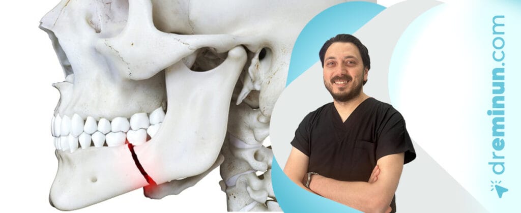 çene kırığı tedavisi kayseri