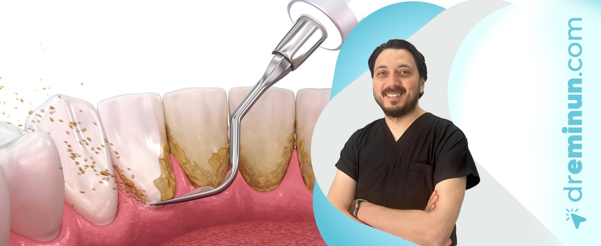 diş taşı ve tarar Temizliği ve Ağız Hijyeni