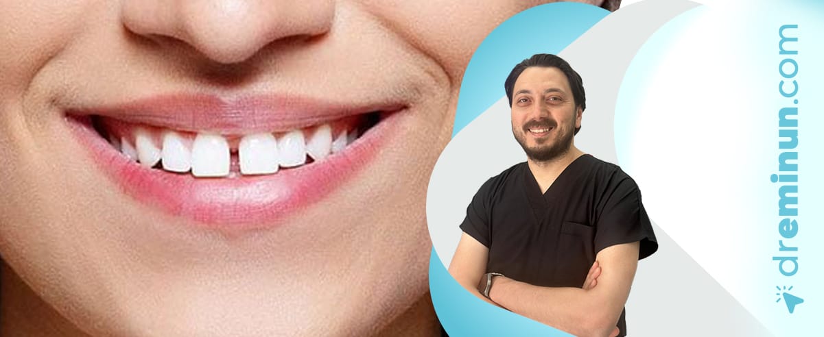 kayseri estetik diş dolgusu ile gülüşünüz canlansın