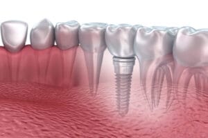 Diş implantı prosedürü sırasında kullanılan teknolojik cihazlar – 2025
