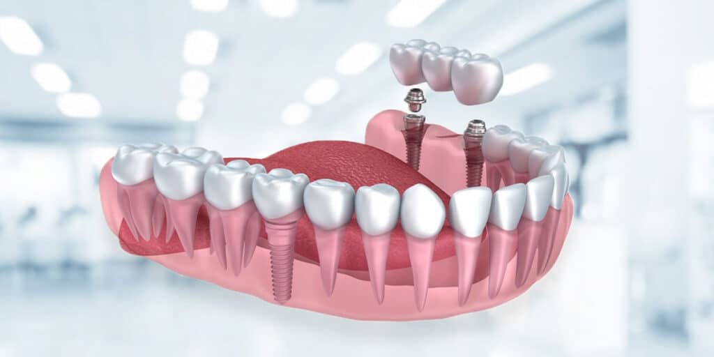 cerrahi implant tedavisi hakkında merak edilenler