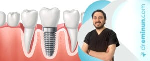 Kayseri İmplant Tedavisi | Doktor Emin ÜN ile Kalıcı Diş Çözümleri